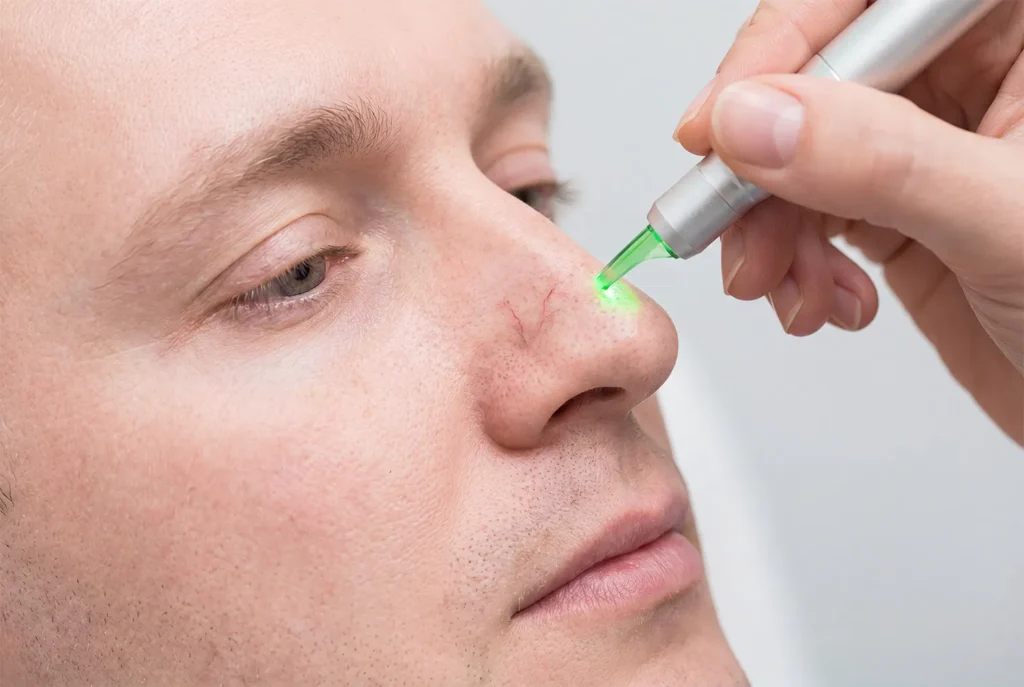 Laser or Energy-Based Treatment for Small Surface Vessels